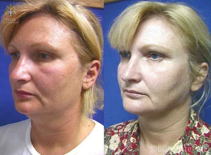 A result from Patel Plastic Surgery