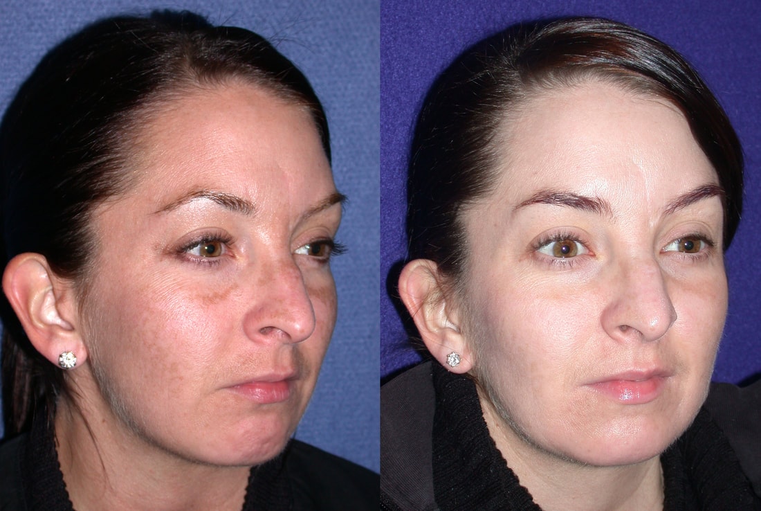 A result from Patel Plastic Surgery