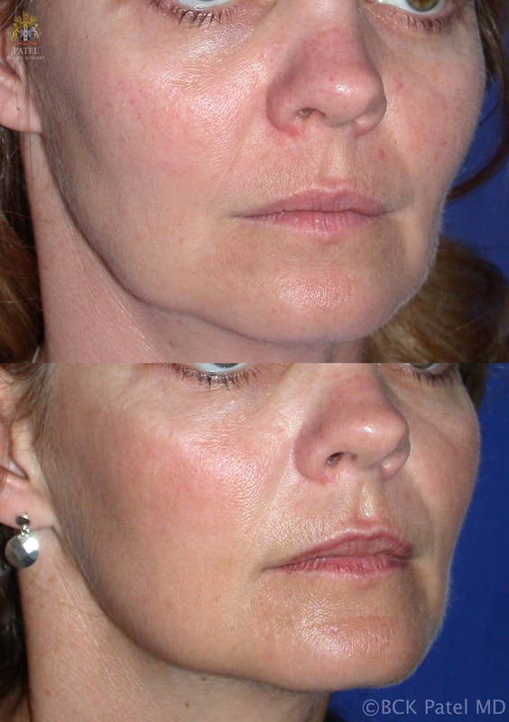 A result from Patel Plastic Surgery