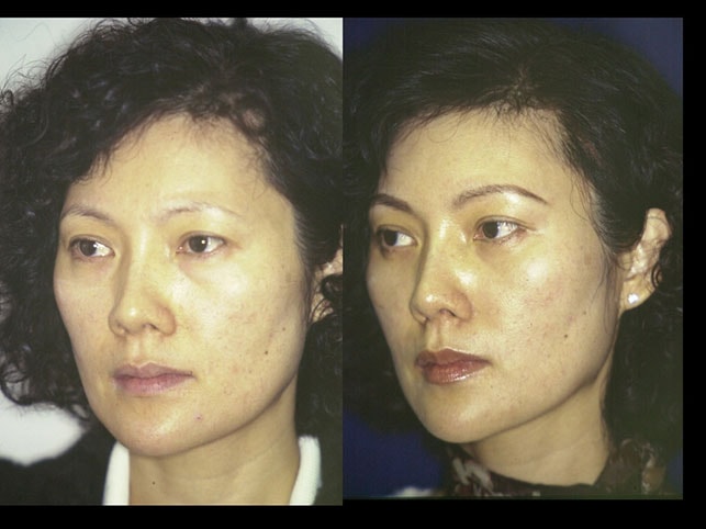 A result from Patel Plastic Surgery