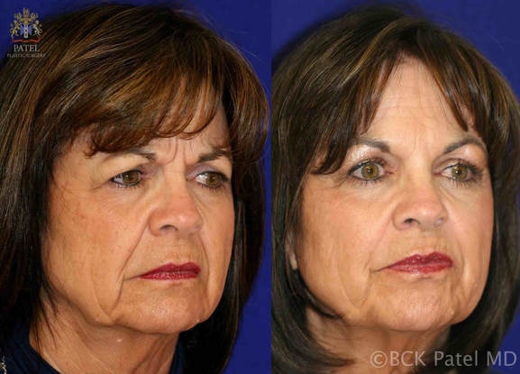 A result from Patel Plastic Surgery