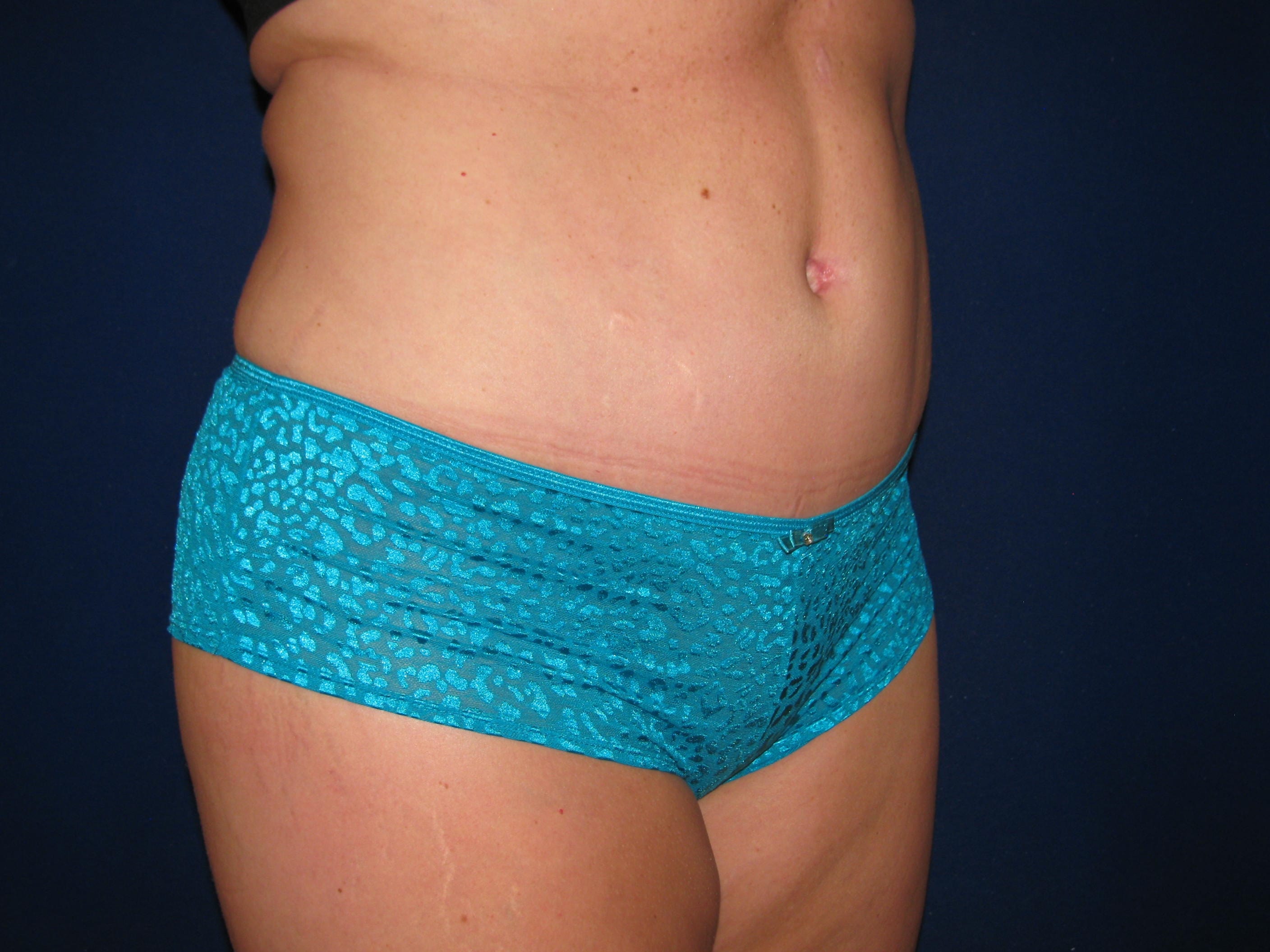 A result from LV Plastic Surgery (Brian J. Parker, MD)