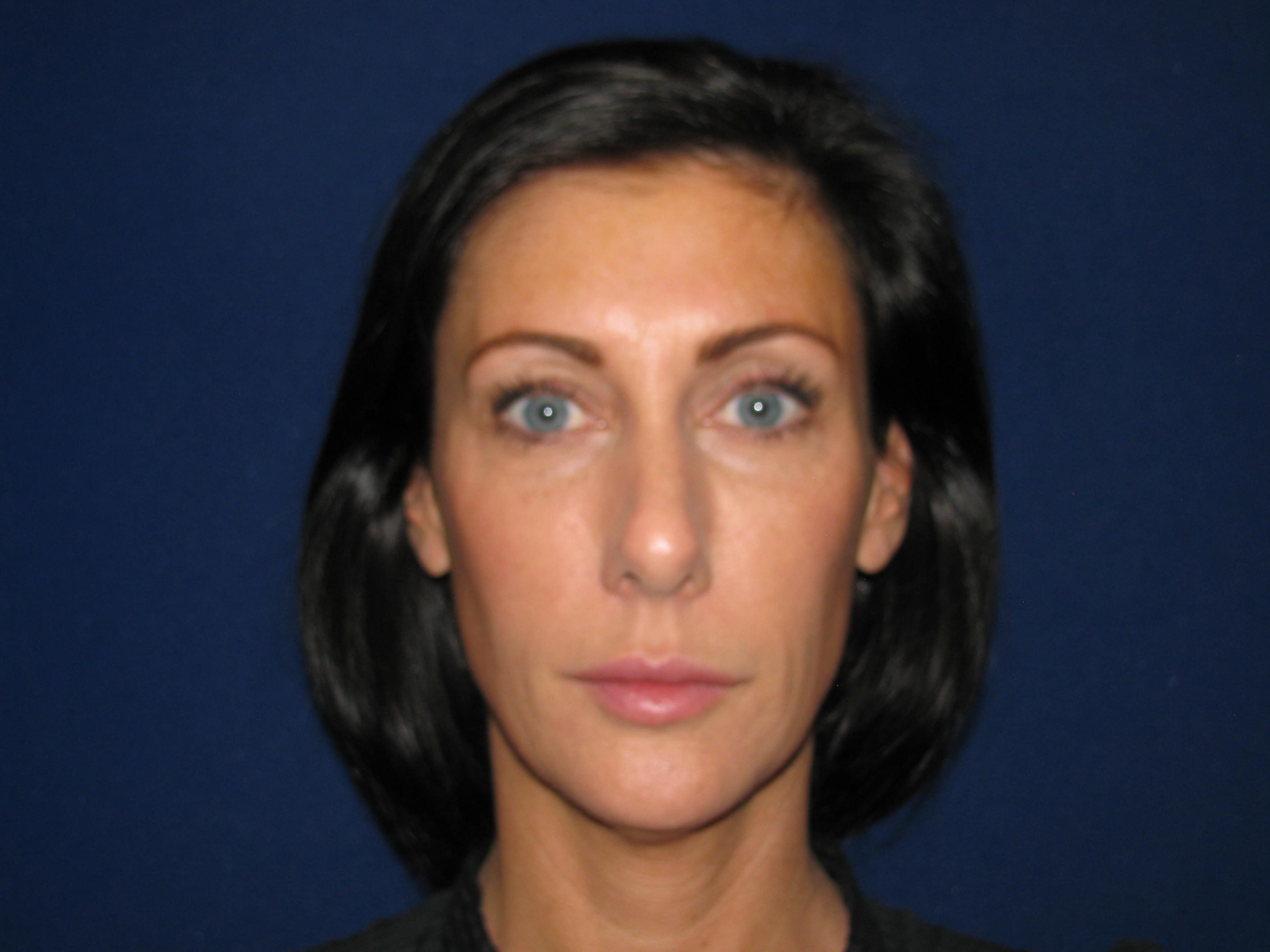 A result from LV Plastic Surgery (Brian J. Parker, MD)