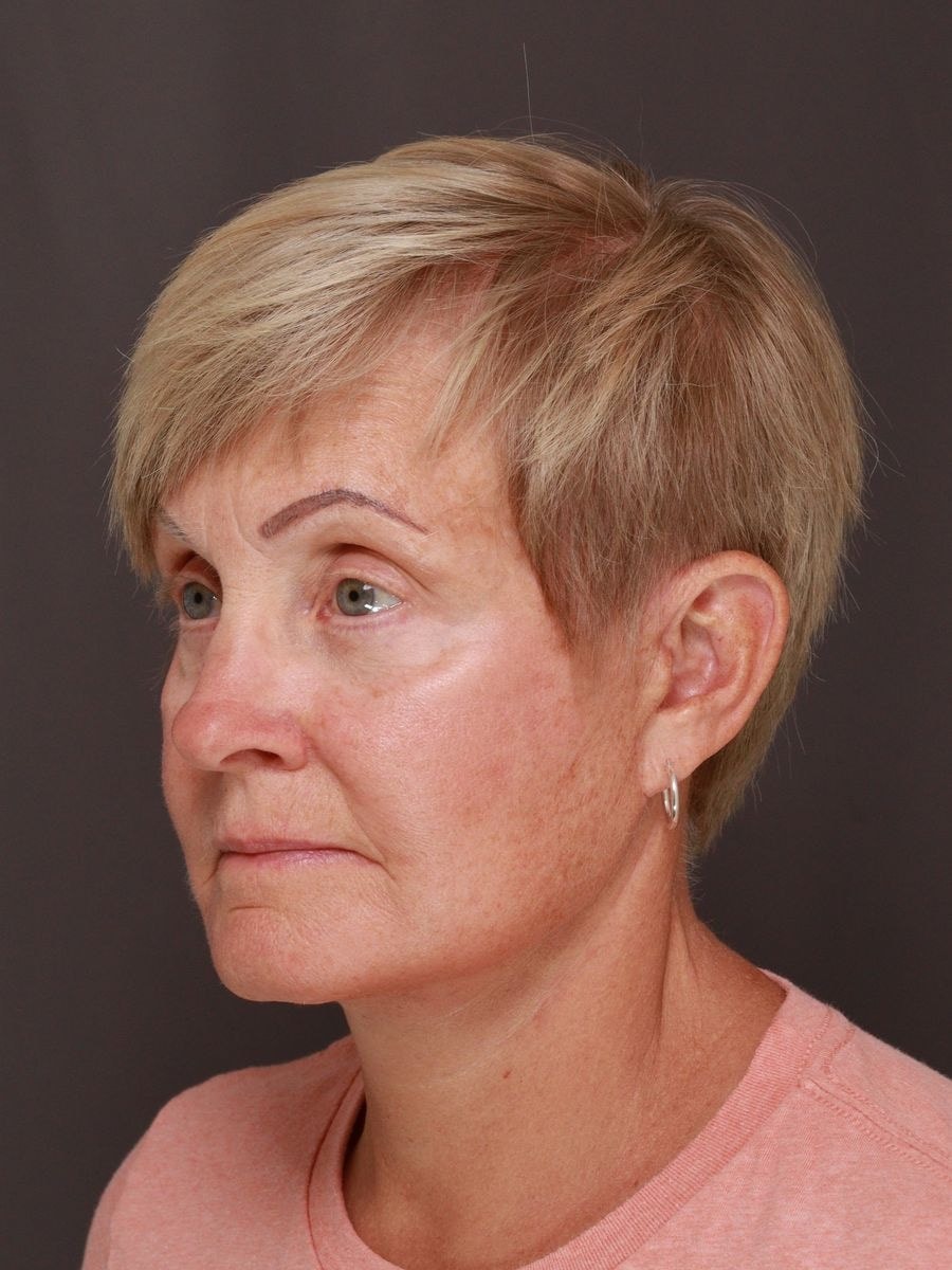 A result from Manning Facial Plastic Surgery