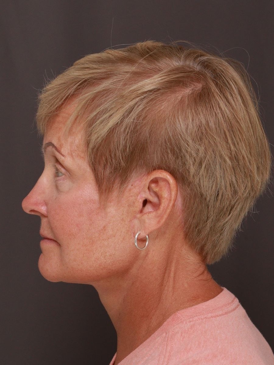 A result from Manning Facial Plastic Surgery