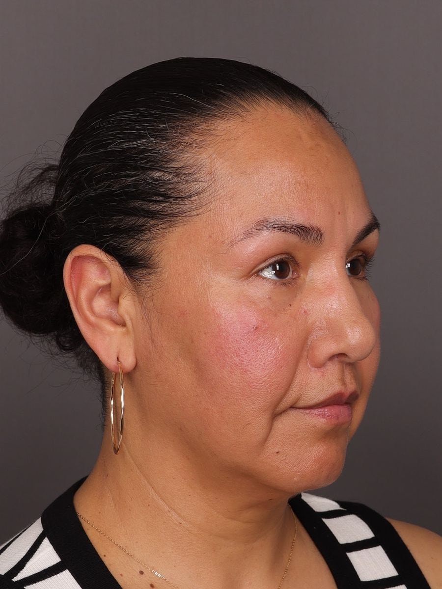 A result from Manning Facial Plastic Surgery