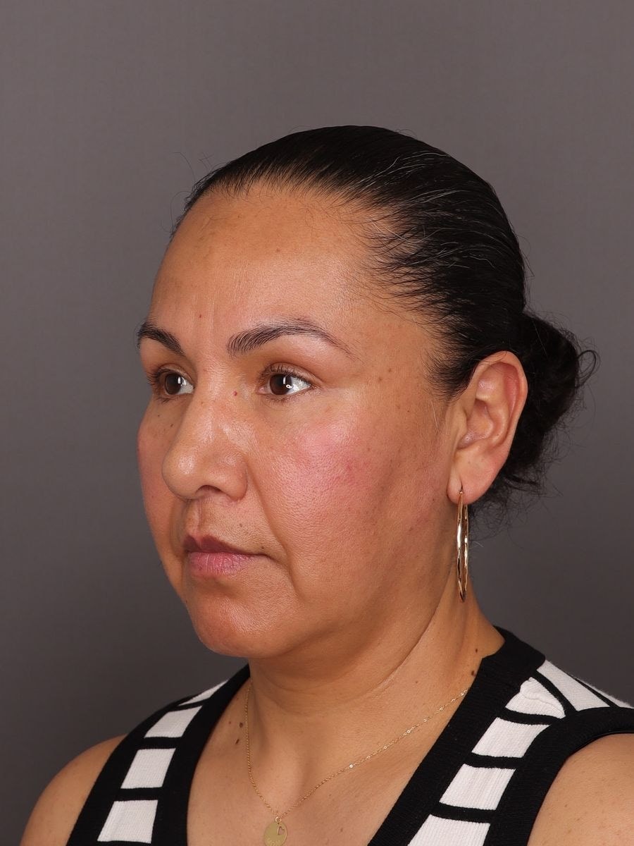 A result from Manning Facial Plastic Surgery