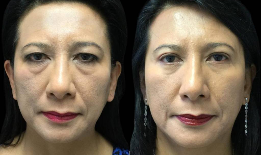 A result from Bitar Cosmetic Surgery Institute & Medspa