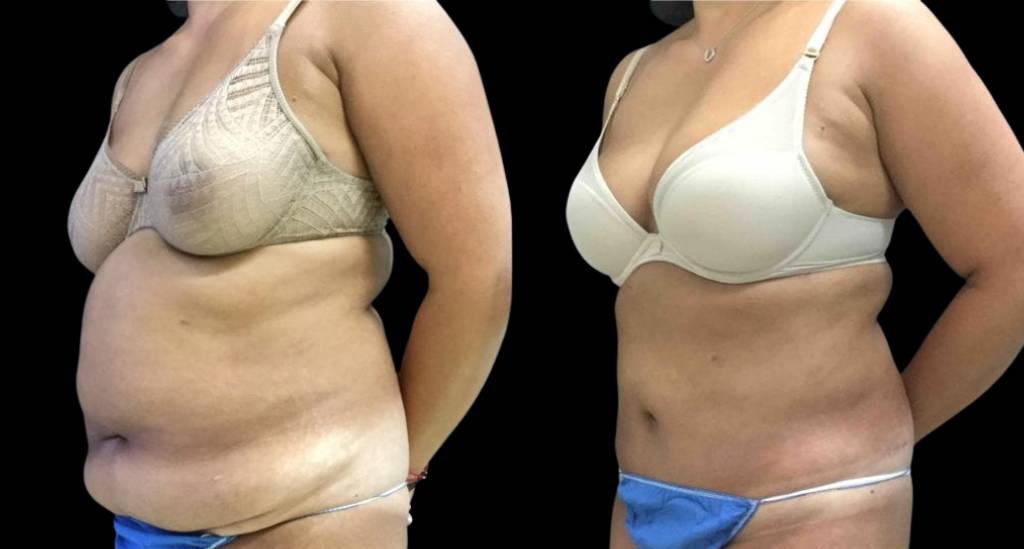 A result from Bitar Cosmetic Surgery Institute & Medspa
