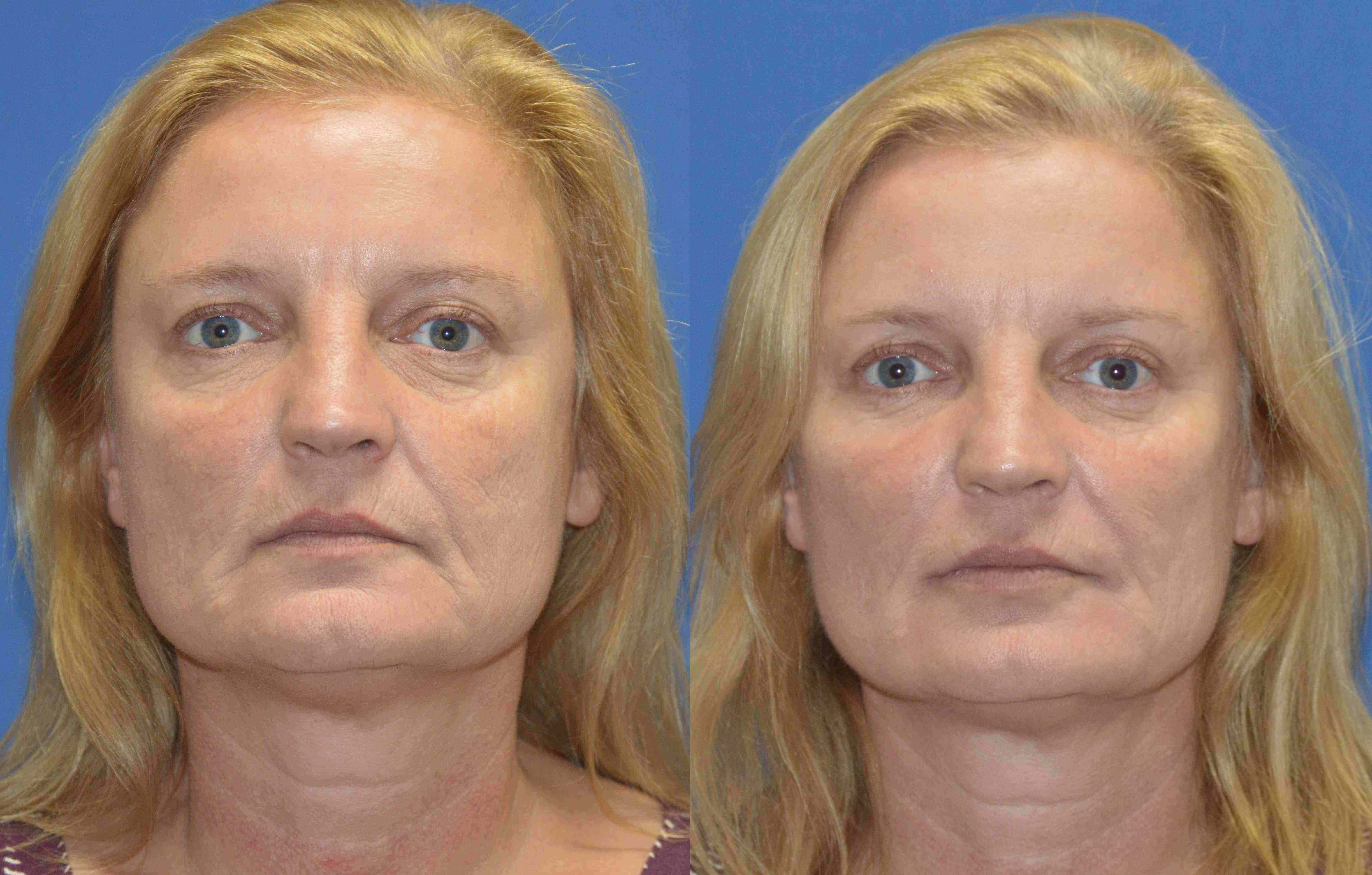 A result from Golden Triangle Facial Plastic Surgery