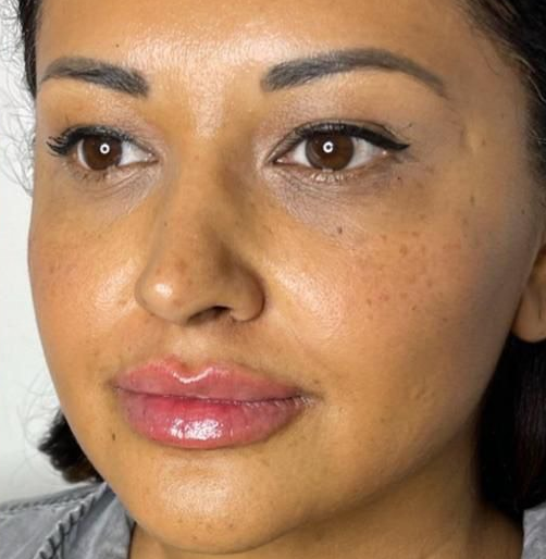 A result from Suddenly Slimmer Med Spa