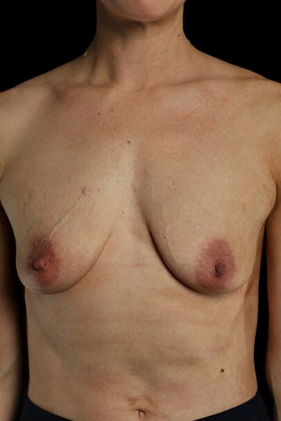 Breast Augmentation before photo