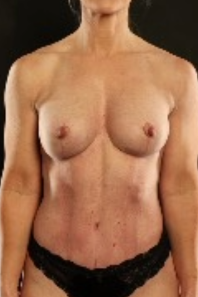 Mommy Makeover result at Garlick Plastic Surgery