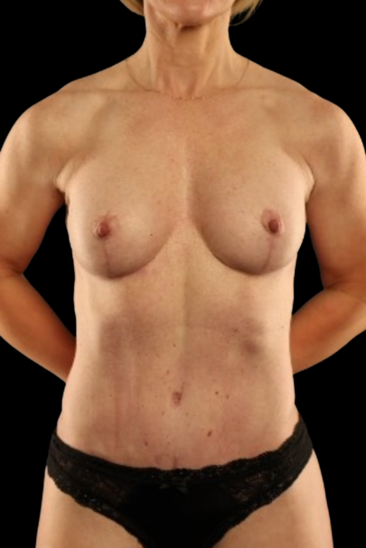 Breast Augmentation result at Garlick Plastic Surgery