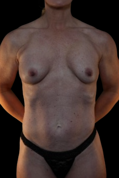 Breast Augmentation before photo