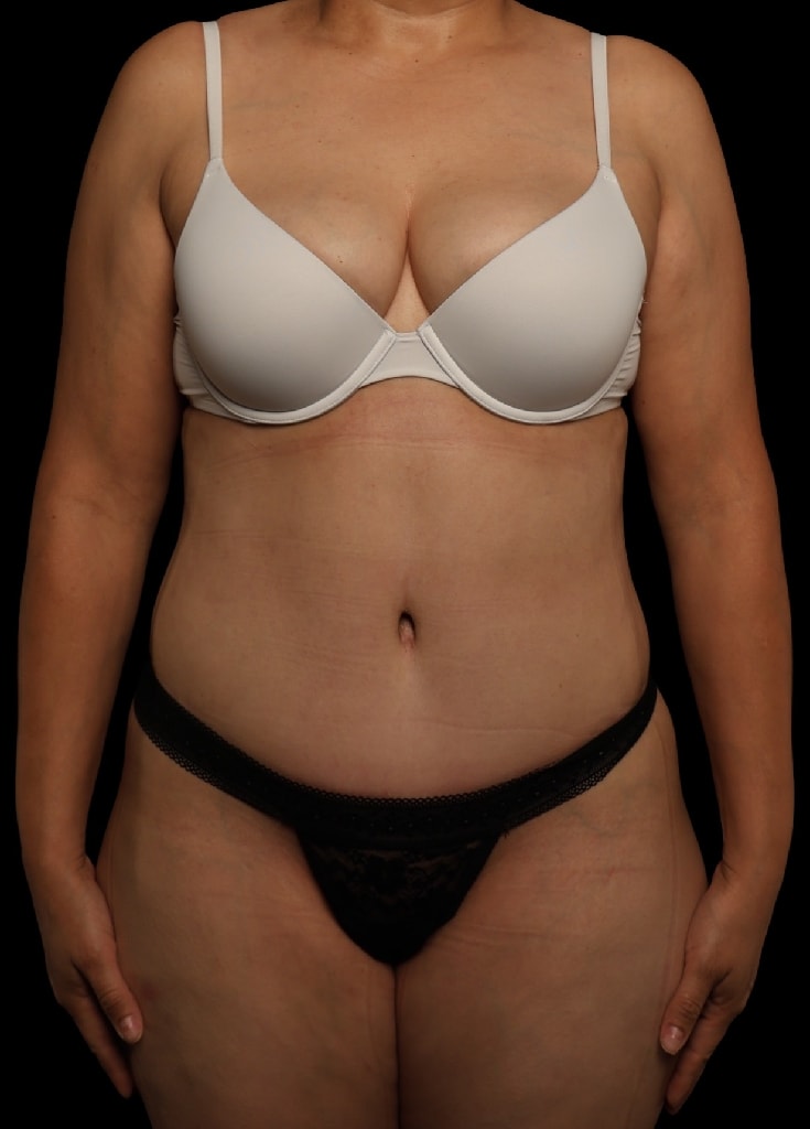 A result from Garlick Plastic Surgery