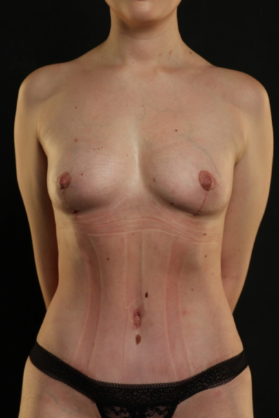 Mommy Makeover result at Garlick Plastic Surgery