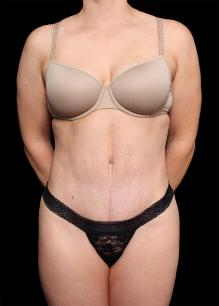 Garlick Plastic Surgery tummy tuck after — Salt Lake Valley, UT