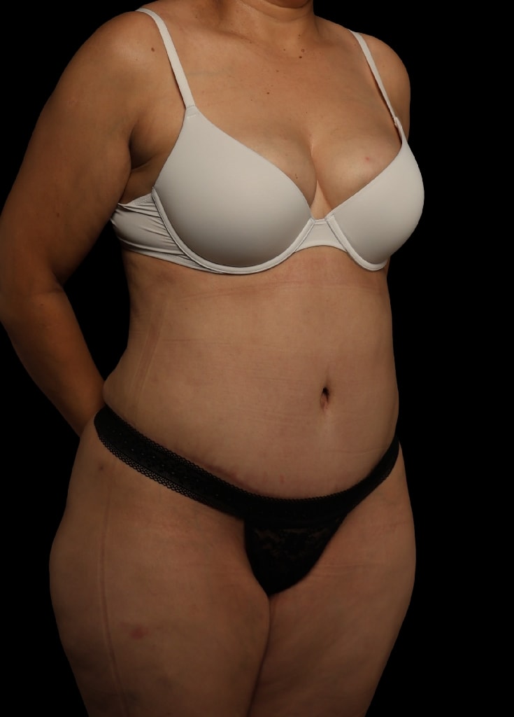 A result from Garlick Plastic Surgery