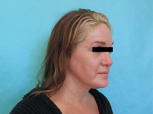 A result from Buffalo Plastic Surgery
