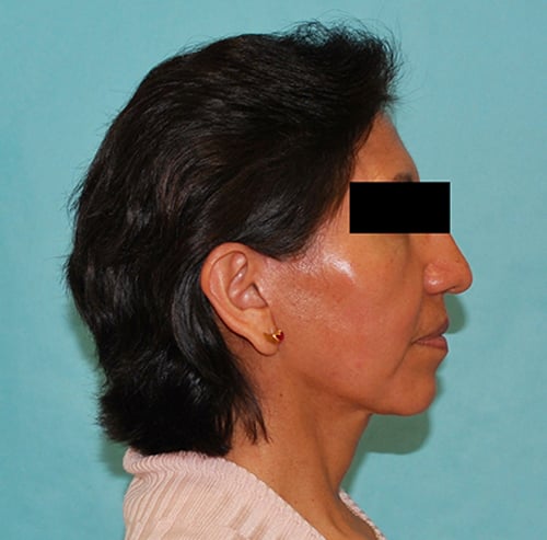 A result from Buffalo Plastic Surgery