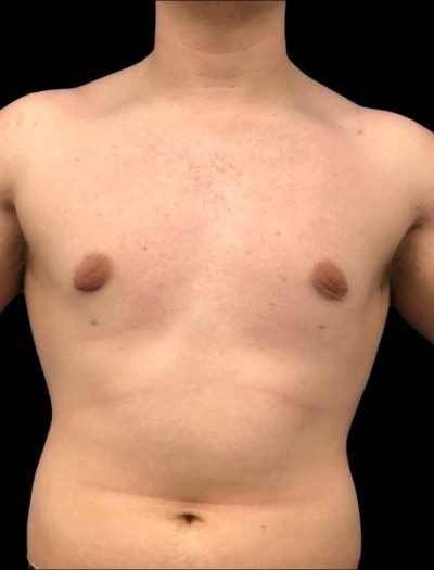 A result from Defyne Plastic Surgery