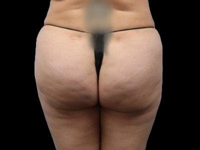 A result from Defyne Plastic Surgery