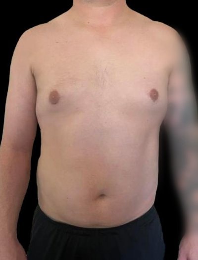 A result from Defyne Plastic Surgery