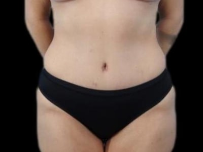 A result from Defyne Plastic Surgery