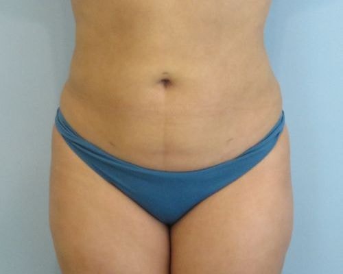 A result from Aspira Plastic Surgery & Med Spa: Dr. Venkata Erella