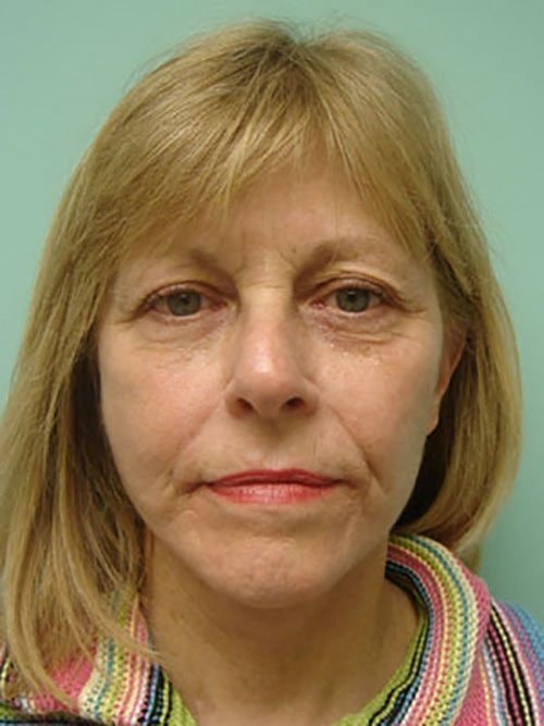 A result from Aspira Plastic Surgery & Med Spa: Dr. Venkata Erella