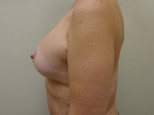 A result from Aspira Plastic Surgery & Med Spa: Dr. Venkata Erella