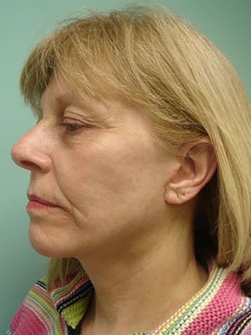 A result from Aspira Plastic Surgery & Med Spa: Dr. Venkata Erella