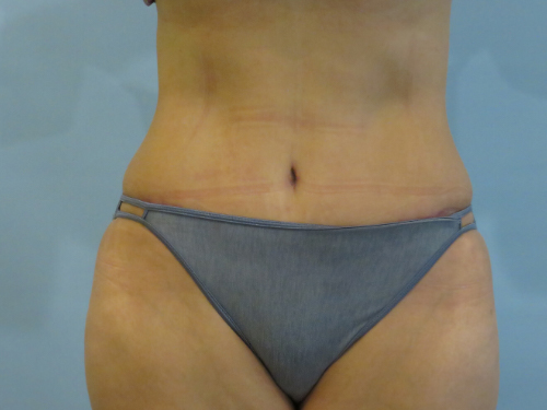 A result from Aspira Plastic Surgery & Med Spa: Dr. Venkata Erella