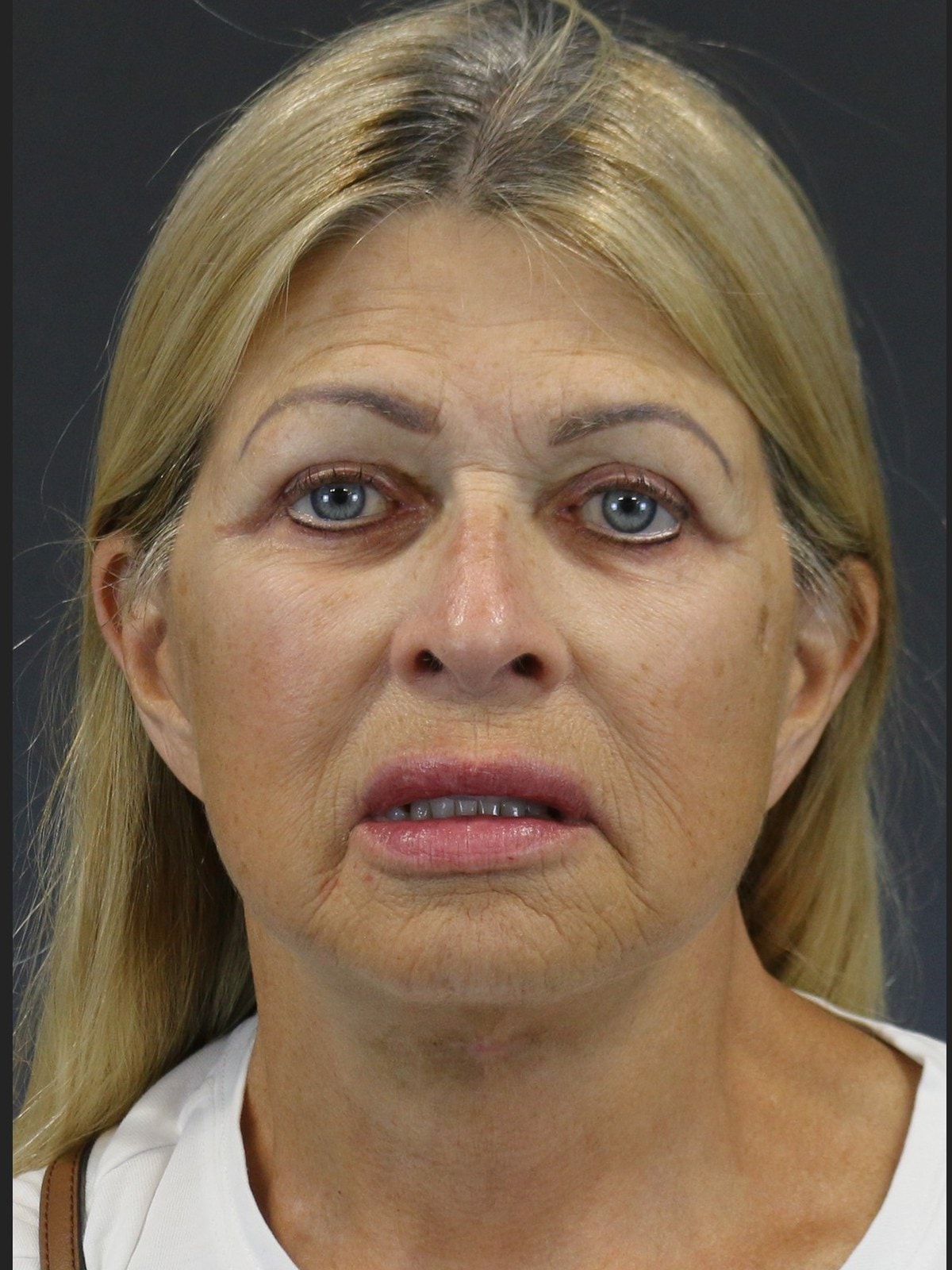 A result from FaceLove Facial Plastic Surgery