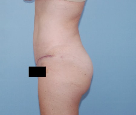 A result from Robert Kearney, MD, FACS