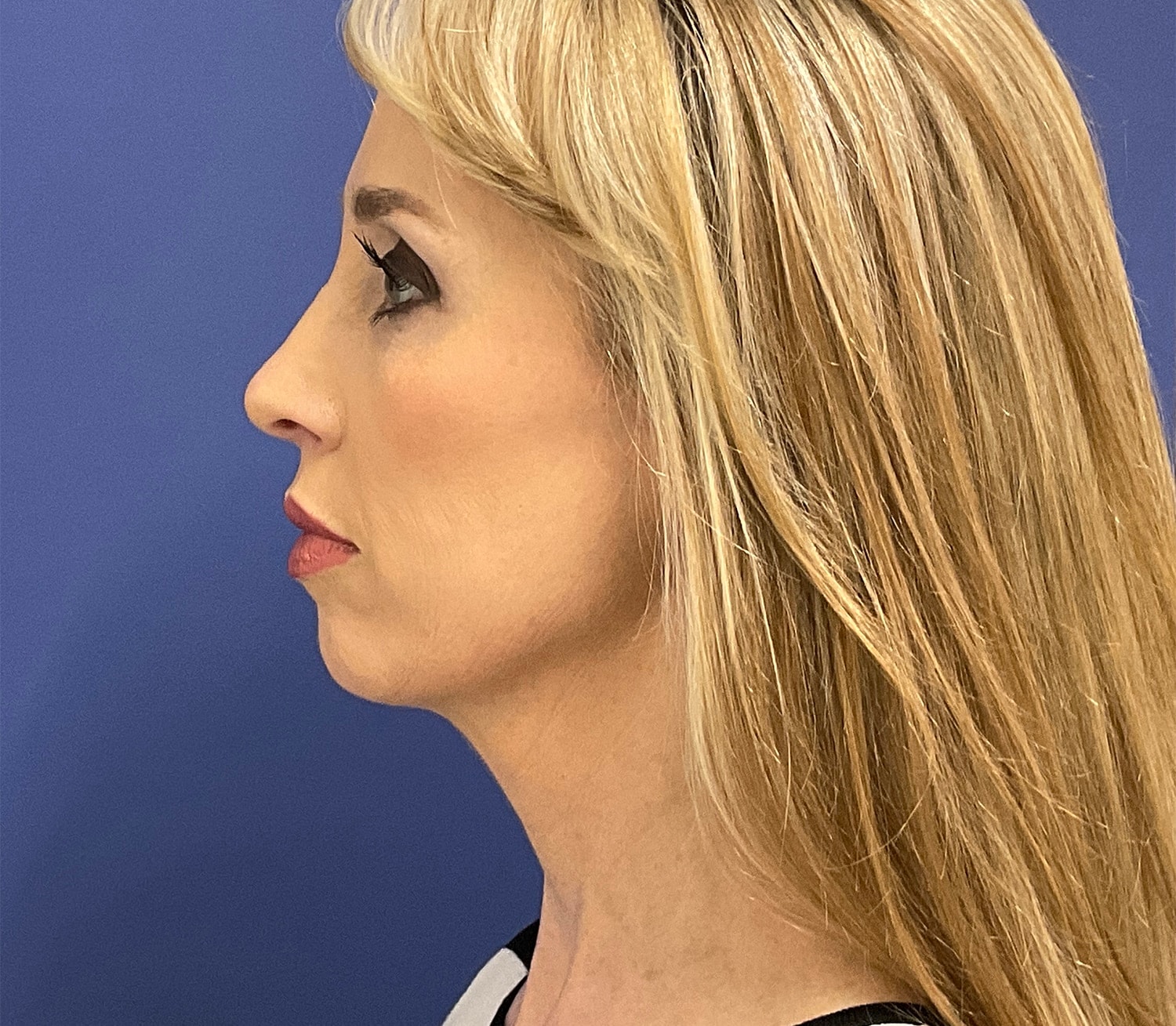 A result from Robert Kearney, MD, FACS