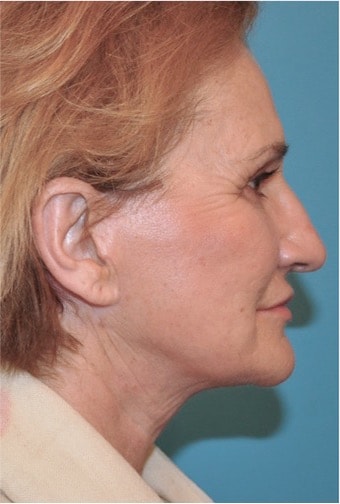 A result from Luxurgery