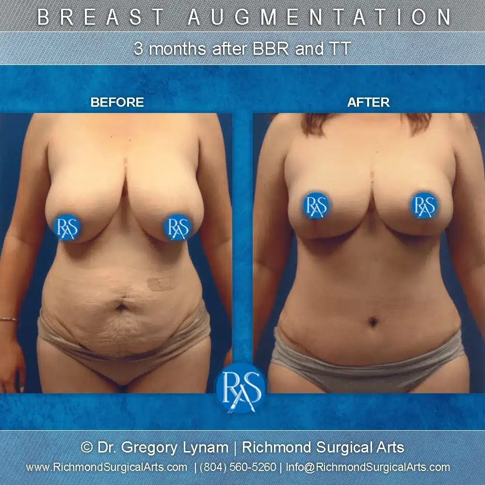 A result from Richmond Surgical Arts