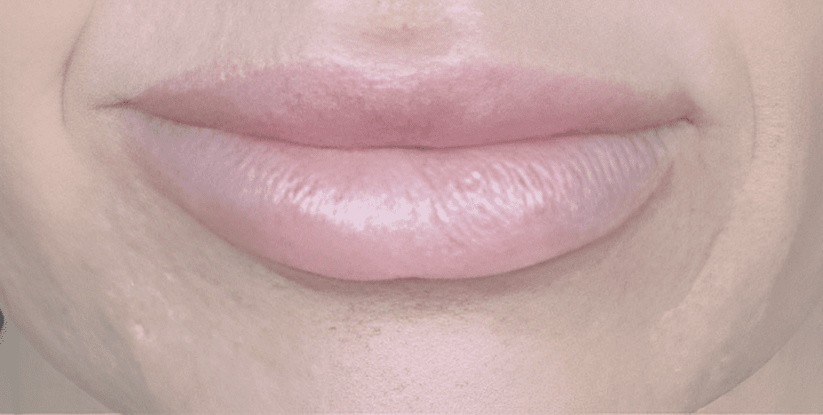 A result from ABQ Medical Spa