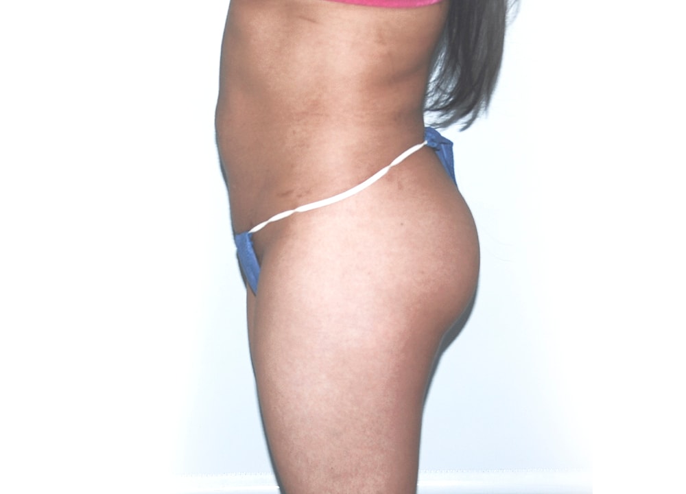 A result from Dr. Ron Soltero FACS
