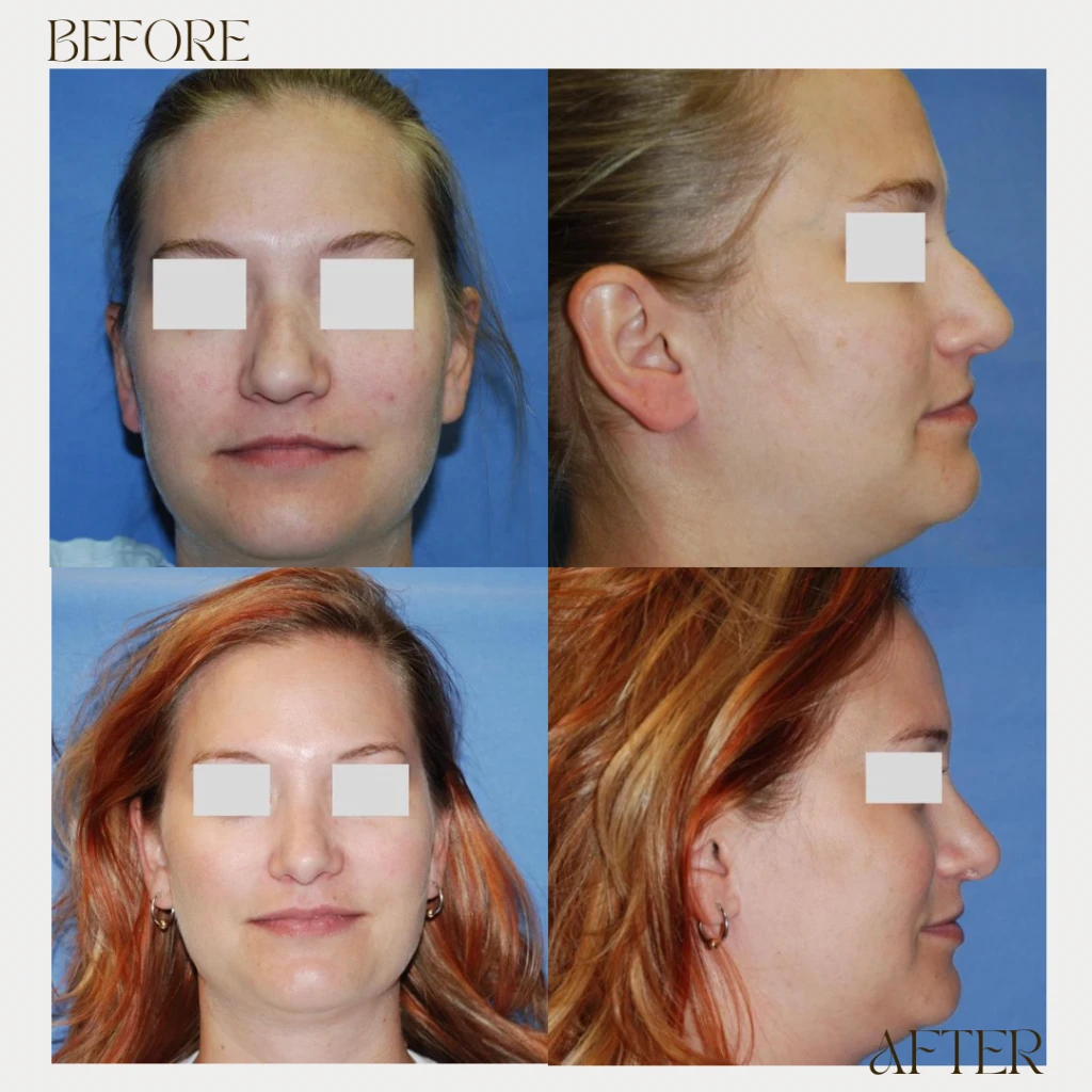 A result from Ashby Plastic Surgery & Aesthetics: Eric R Ashby MD