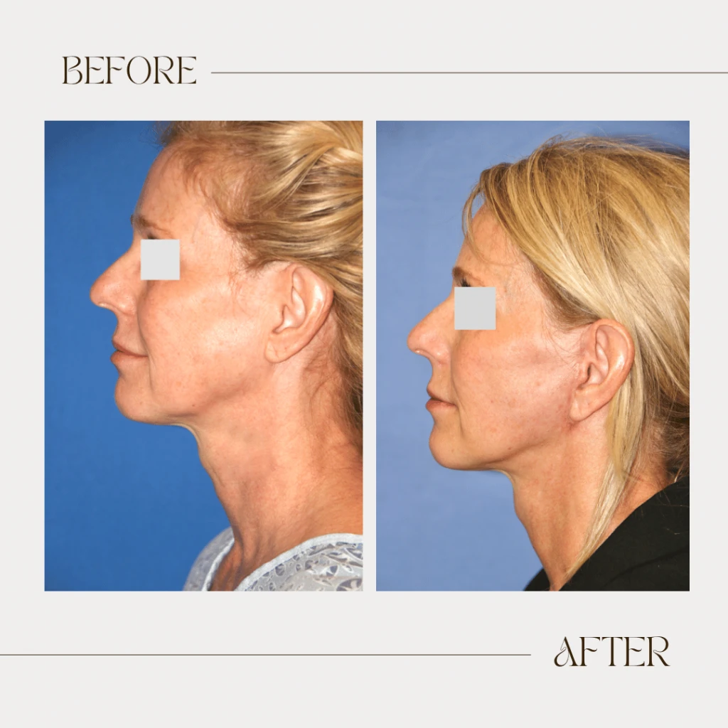A result from Ashby Plastic Surgery & Aesthetics: Eric R Ashby MD