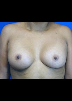 A result from Ilumaforma Aesthetic Surgery