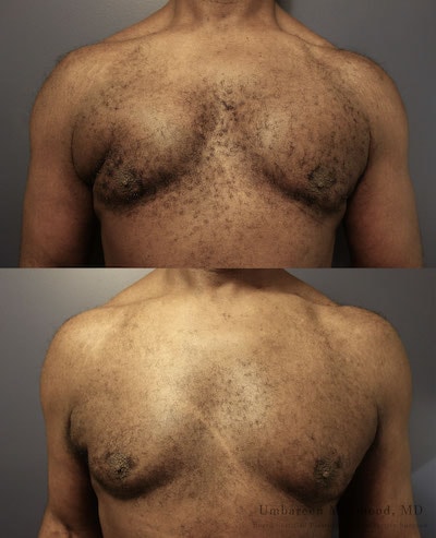 A result from Umbareen Mahmood, MD