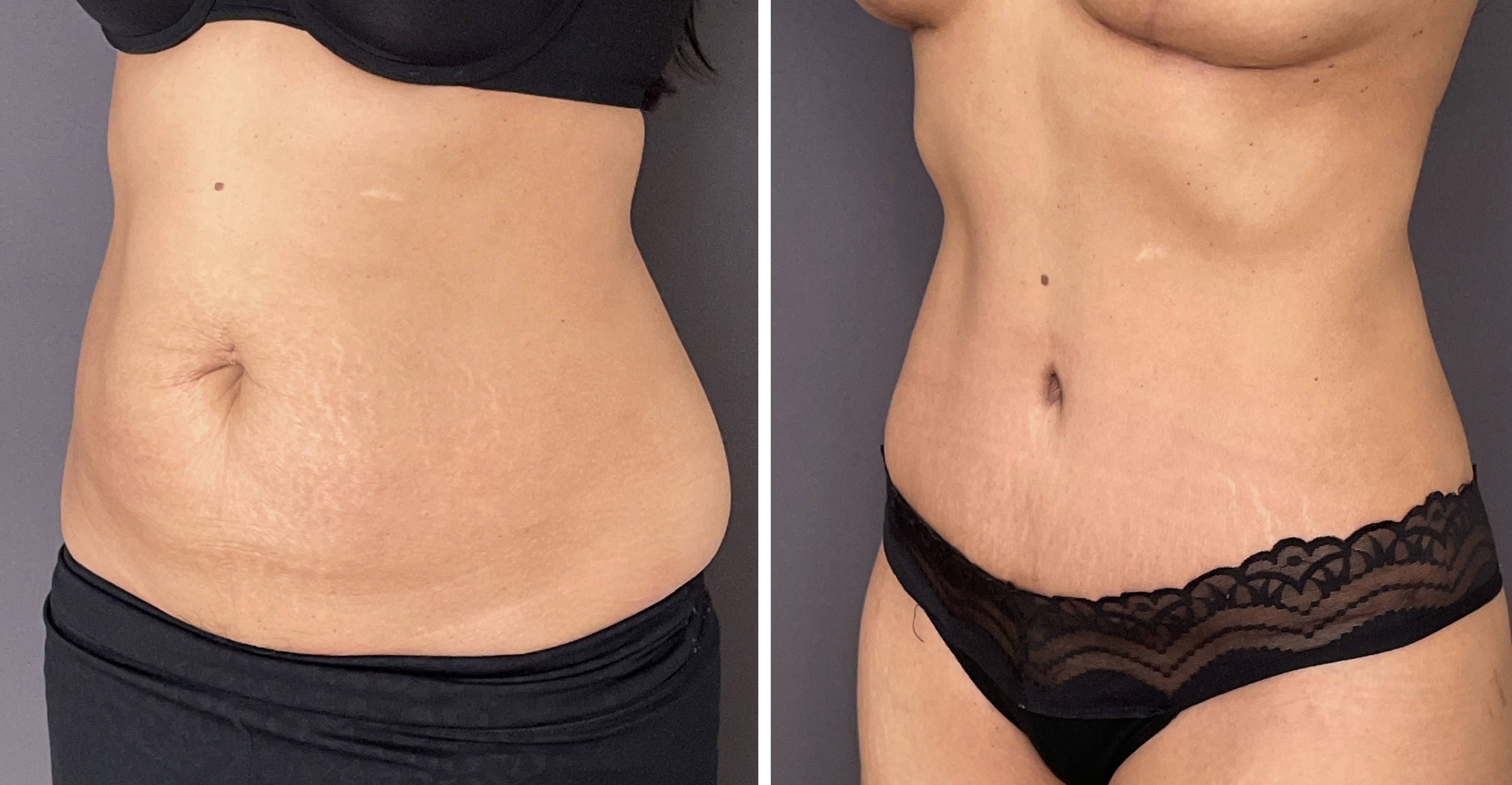 A result from Umbareen Mahmood, MD
