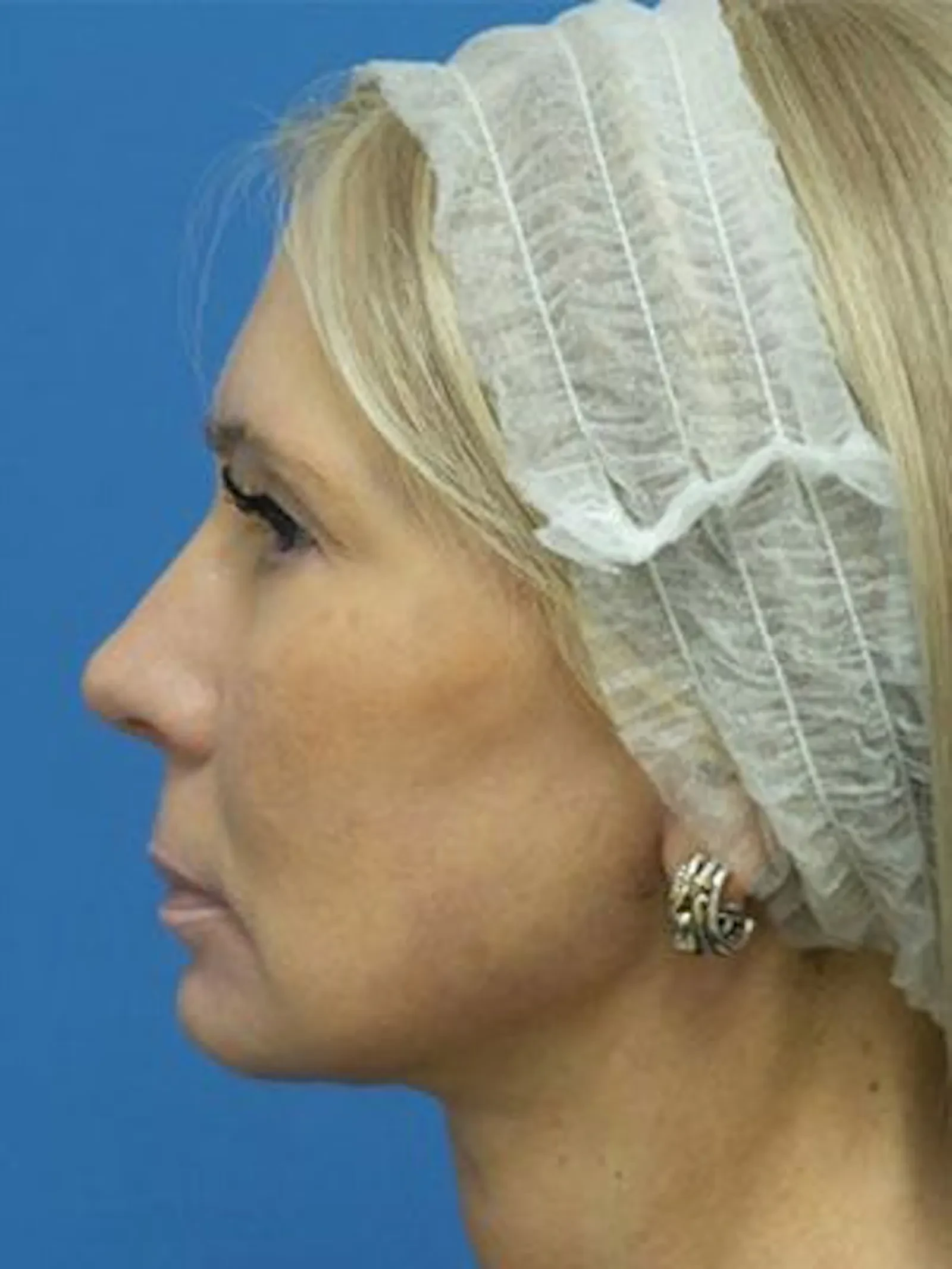 A result from Concierge Aesthetics & Plastic Surgery - Northbrook