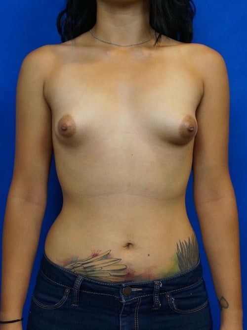 Breast Augmentation before photo