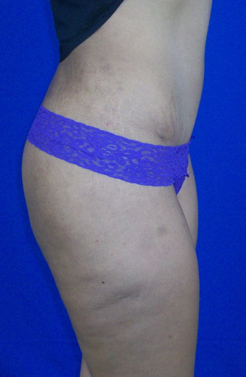 VIP Plastic Surgery tummy tuck after — Henderson, NV