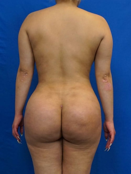 Liposuction result at VIP Plastic Surgery